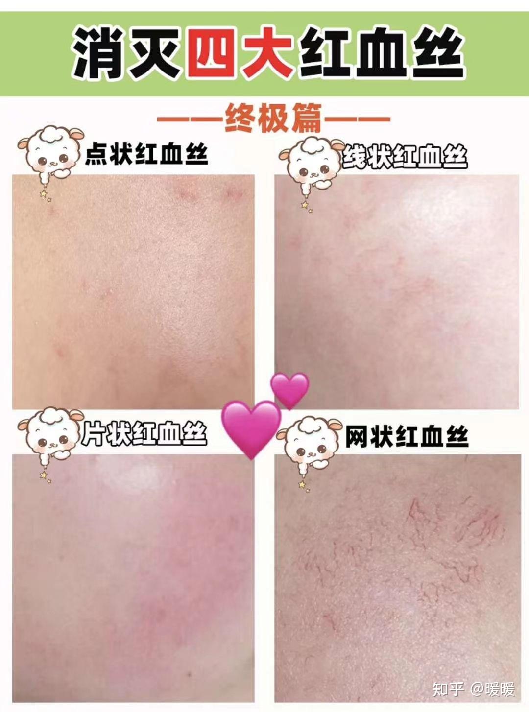 这4个部位长出红血丝赶紧去医院！拖着不管该生大病了