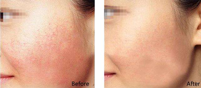 敏肽红颜柔肤水对敏感肌肤对红血丝或者有没有效果？